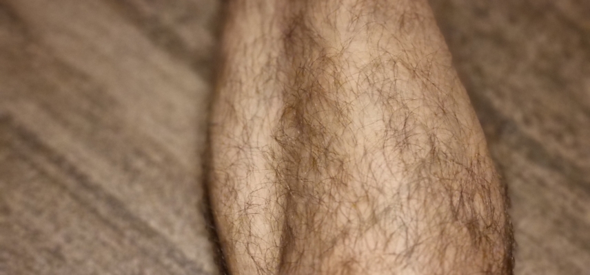 Shin Splints (MTSS) – Przyczyny, Objawy i Skuteczna Terapia