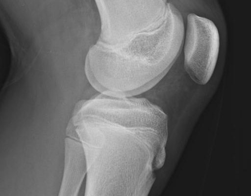 Osgood-Schlatter