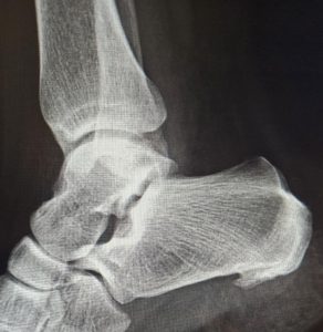 Ostroga piętowa, fizjoterapia, terapia manualna