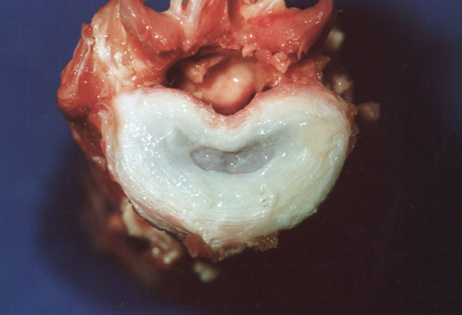 Dysk Międzykręgowy: 10 Faktów i Mitów, Które Musisz Znać! | Fizjoterapia Kręgosłupa Będzin